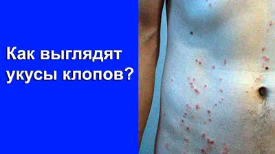 Как выглядит укус постельного клопа на человеке? Фото - СЭС