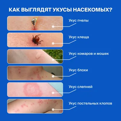 Укусила мошка: симптомы, последствия, лечение, фото укусов