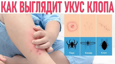 Укусы постельных клопов: специфика, симптомы и лечение