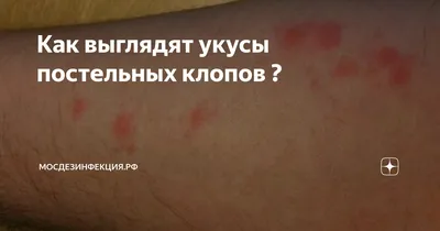 Мазь от укусов клопов — купить в интернет-магазине по низкой цене на Яндекс  Маркете