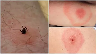 Симптомы укуса комара, блох, пчел - как их распознать | РБК Украина