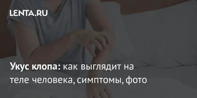 Как выглядит укус блохи на теле человека | Статьи санитарной службы