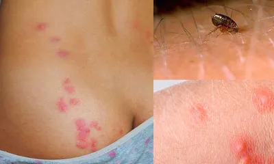 Аллергия на укусы насекомых (отек, зуд) – симптомы, проявление и лечение