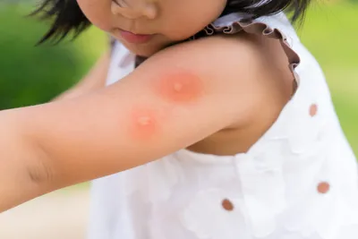 Что делать если укусил комар или другое насекомое: пчела, шмель, оса,  шершень