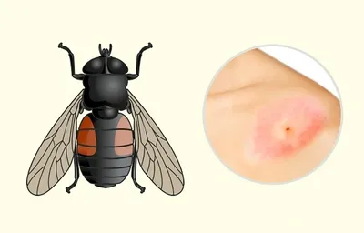 Это не укус комара: 7 признаков рака кожи, на которые никто не обращает  внимания