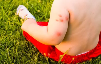 Что помогает от укусов комаров: чем помазать ребенку, гели и средства для  снятия зуда