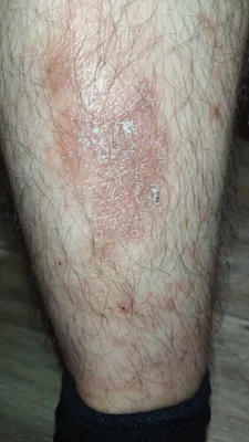 Отзыв о Капли от аллергии Sanofi \"Зодак\" | страшное фото моих ног))) при  аллергии на укусы домашних блох