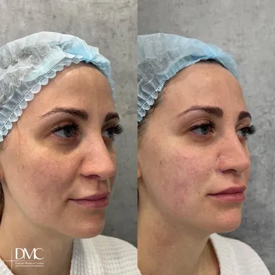 Фото до и после аппаратной косметологии | Damas Medical Center