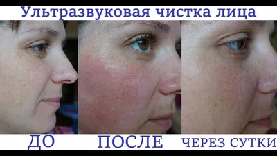 Вакуумная чистка лица HydraFacial в Москве: цены, фото до и после, отзывы |  Стоимость вакуумной чистки лица HydraFacial в клинике Seline