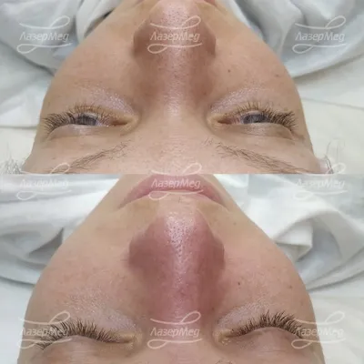 Ультразвуковая чистка лица: фото до и после, отзывы специалистов, как  проходит процедура