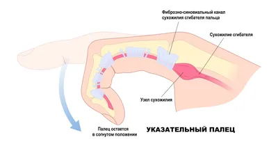 Шишка на руке - фото и картинки: 66 штук