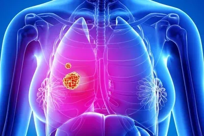 Рак грудной клетки: симптомы и признаки, виды, диагностика и лечение рака  грудного отдела