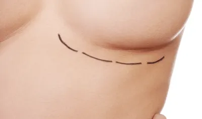 Как проходит операция по увеличению груди | Nuevo Clinic