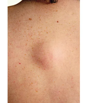 Что такое эпидермальная киста кожи: удаление подкожной кисты в Лазерсвiт
