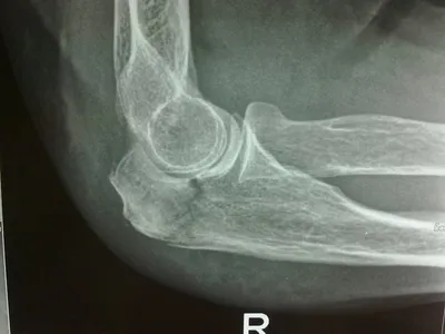 Кубитальный синдром - информация о заболевании в Рязани
