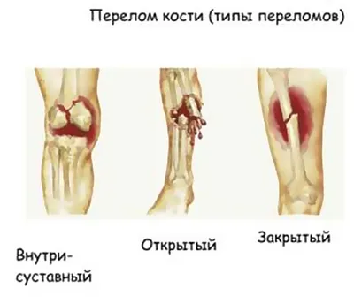 Ушиб локтя : Медицина : Guns.ru Talks