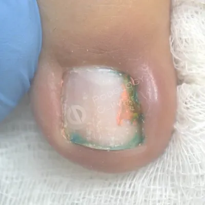 💥 Severe contusion of the big toe🤯Injury of the nail 🙈Onycholysis -  YouTube