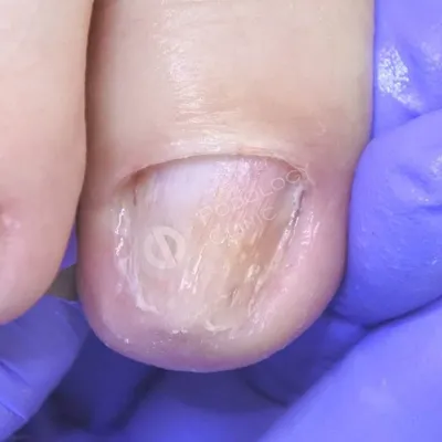 💥 Severe contusion of the big toe🤯Injury of the nail 🙈Onycholysis -  YouTube