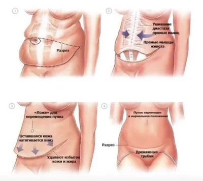 Послеродовая пластика (абдоминопластика+ушивание диастаза) | Пикабу