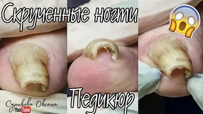 Лечение ногтей СПб. Лечение болезней ногтей в Nail Clinic