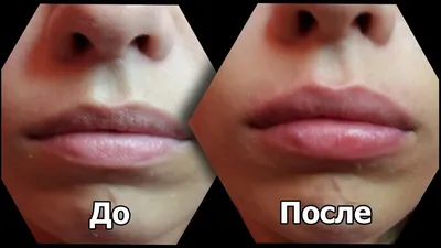Коррекция и увеличение губ филлерами и гиалуроновой кислотой в клинике  «Вектор» в Москве