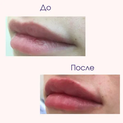 Увеличение губ Харьков - ⭕️А на этом фото хочу показать трансформацию губ  из предыдущего поста🔜 ⠀ ▫️На первичную процедуру пациентка 4 месяца назад,  провели процедуру препаратом Стилейдж 1 мл. ▪️В мае добавили