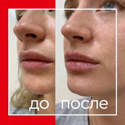 Увеличение губ в СПб в Клинике \"Нарвская\", цена от 7000 рубл.