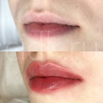 Увеличение губ, контурная пластика губ – салон красоты Fleur г. Луганск