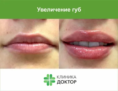 Увеличение губ гиалуроновой кислотой — Damas Medical Center