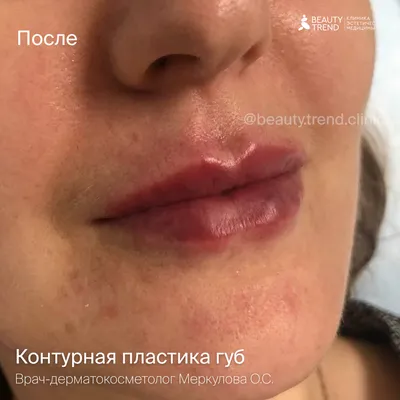 Увеличение и коррекция губ гиалуроновой кислотой в Москве цена, отзывы,  фото - Косметология доктора Корчагиной