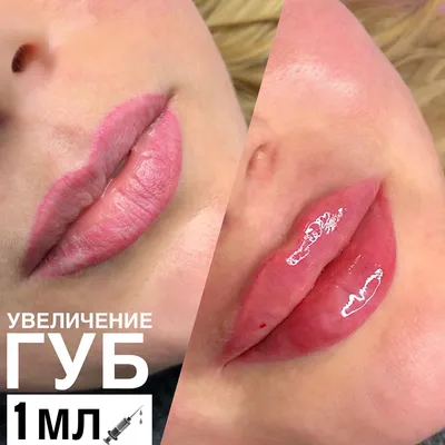 Перманентный Макияж от assema_tatuazh - Часто задаваемые вопросы: ПЕРМАНЕНТ  💋 УВЕЛИЧЕНИЕ. Что делать ПЕРВЫМ ⁉️ ⠀ 🔸МОЖНО ЛИ ДЕЛАТЬ ТАТУАЖ ГУБ ПОСЛЕ  ГИАЛУРОНОВОЙКИСЛОТЫ? Можно, но в этом нет смысла. После распада молекул