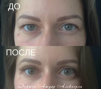 Операция лисий взгляд в Киеве на Печерске - Coolaser Clinic