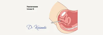 Увеличение точки g фото фото