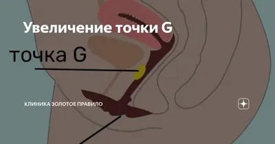 Увеличение точки G. Интимная контурная пластика - YouTube