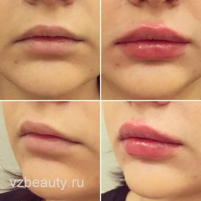 Неудачное увеличение губ: «гиалуроновые усы», «укус пчелы» и другие примеры  с фото