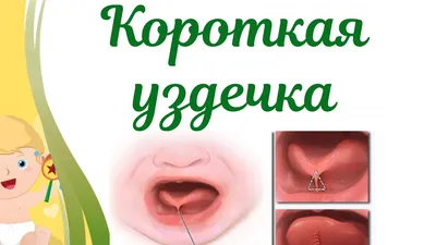 Dr. Ani Hovhannisyan - 👅 Короткая уздечка языка у ребенка (анкилоглоссия)  – укороченная подъязычная связка, препятствующая полному объему движений  языка в ротовой полости. Короткая уздечка языка у ребенка нарушает функцию  сосания, мешает