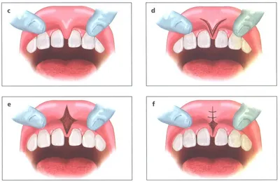 Пластика уздечки языка у ребенка в Бишкеке – Dentistree