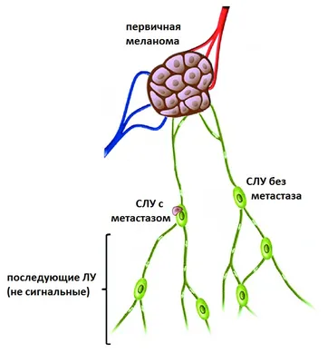 Меланома кожи: как выглядит, симптомы, причины, диагностика, лечение