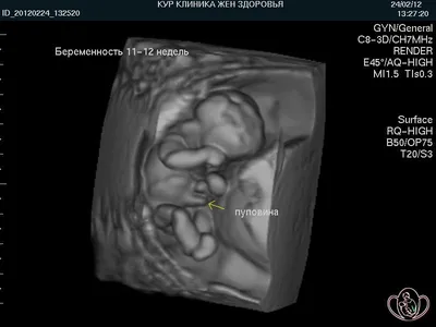 Мальчик или девочка? УЗИ 12 недель и 6 дней — 10 ответов | форум Babyblog