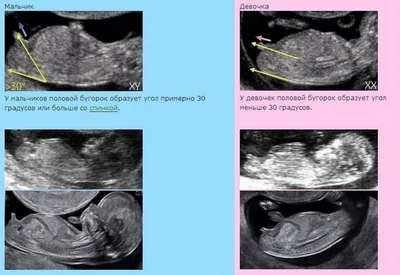 Узи в 16 недель и определение пола ребенка — 17 ответов | форум Babyblog