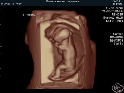 3д/4д УЗИ в Нижнем Новгороде | УЗИ при беременности | Клиника «Ника Спринг»