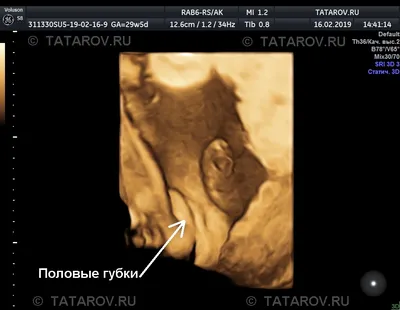 4D УЗИ во время беременности - «3D/4D УЗИ помогло выявить патологию и  вовремя предпринять все необходимые меры (фото для сравнения)» | отзывы