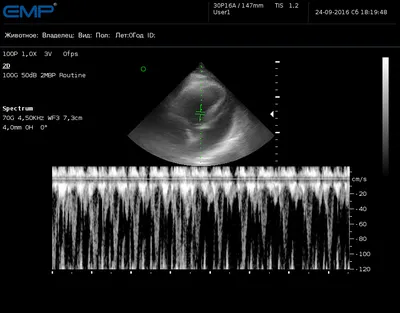 Когда делают УЗИ сердца и что на нем можно увидеть