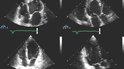 УЗИ сердца в Екатеринбурге - Новая Больница
