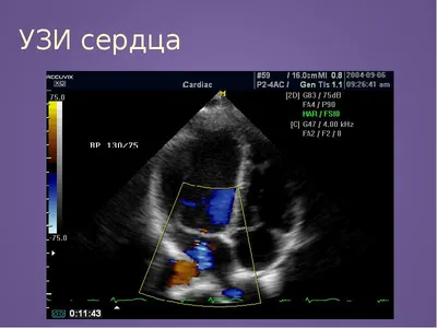 УЗИ сердца — что показывает исследование, как делается, норма у детей,  женщин