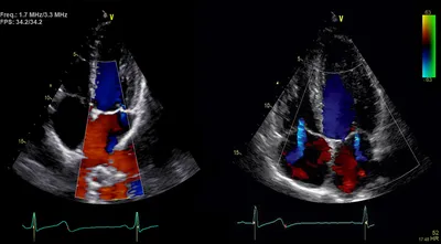 УЗИ сердца в нашей клинике — Клиника Кинзерского