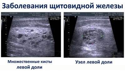 УЗИ щитовидной железы - уточнить стоимость и записаться в «Инпромед» в  Москве