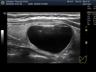 УЗИ щитовидной железы в Новосибирске | Униклиник