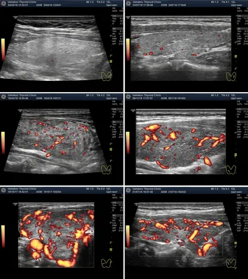 8 признаков отличия рака узла щитовидной железы при УЗИ | Клиника щитовидной  железы | Дзен