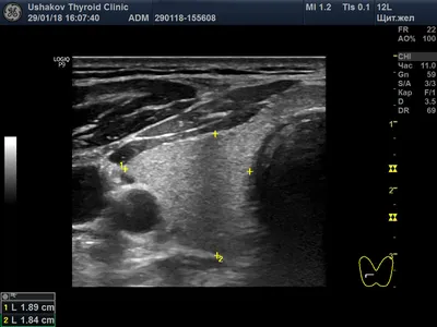 Допплерография ― допплеровское ультразвуковое исследование интенсивности  кровотока узлов щитовидной железы. Клиника Щитовидной Железы доктора А. В.  Ушакова ― официальный сайт.